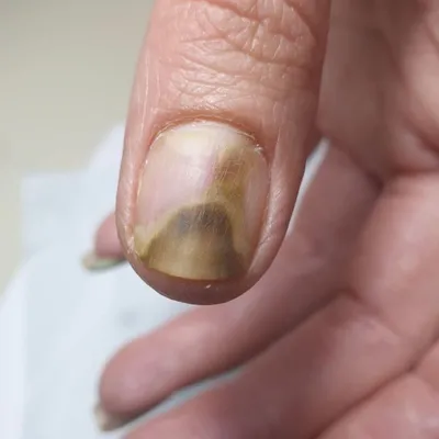 Картинка грибка ногтей на руках