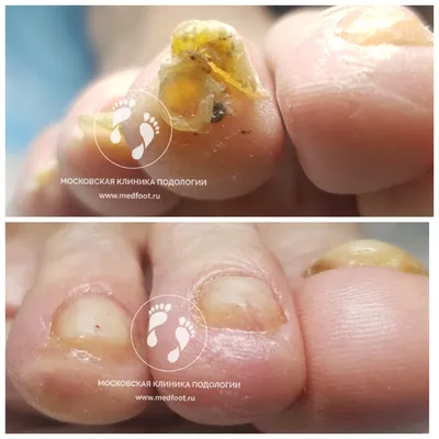 Фото грибка ногтей на руках в формате PNG