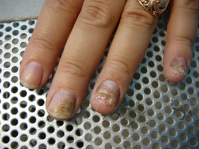 Фотография рук с грибком ногтей