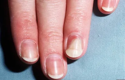 Изображение грибка ногтей на руках: высокое качество