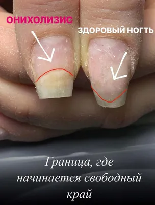 Изображение грибка ногтей на руках: выберите размер