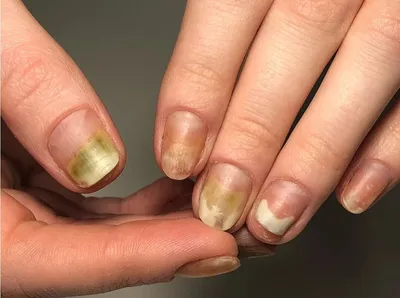 Фотографии грибка ногтей на руках: что нужно знать о болезни