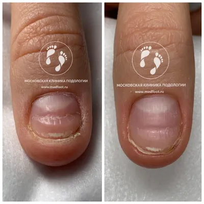 Грибок ногтей на руках: фото до и после лечения