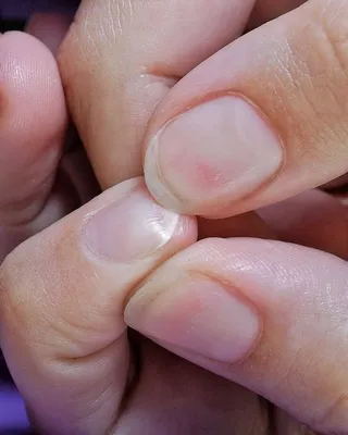 Фотка грибка ногтей на руке для лекции