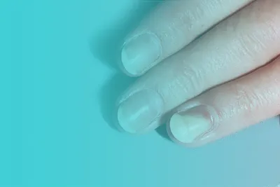 Фотография грибка ногтей на руке для исследовательской работы