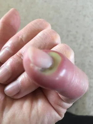 Фотография грибка ногтей руки
