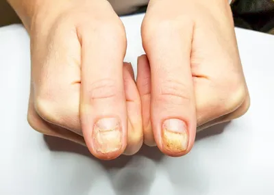 Изображение грибка ногтей руки