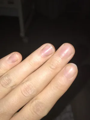 Формат JPG грибка ногтей руки