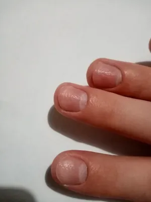 Фото грибка на ногте руки