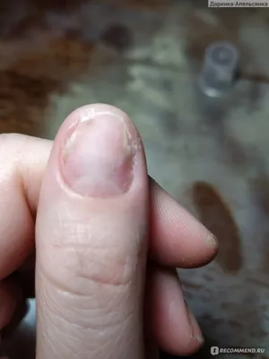 Изображение грибка на ногте руки