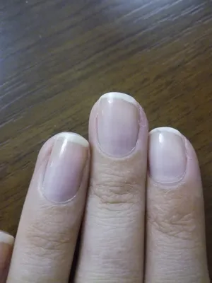 Фотка грибка на ногте руки