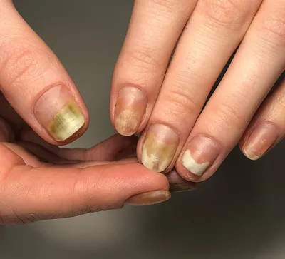 Фотография руки с грибком ногтя в высоком качестве
