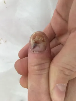 Изображение грибка ногтя на руке в PNG