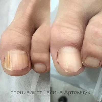 Фото грибка ногтя на руке: визуальное руководство по лечению