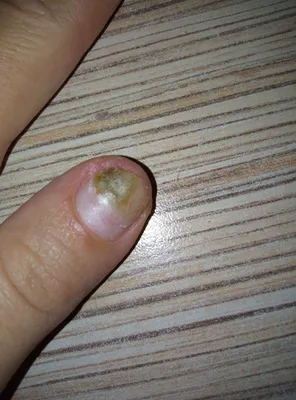 Фотография грибка ногтя на руке: перед и после лечения