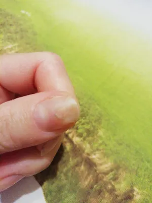 Фотография грибка ногтя на руке: лечение лазером