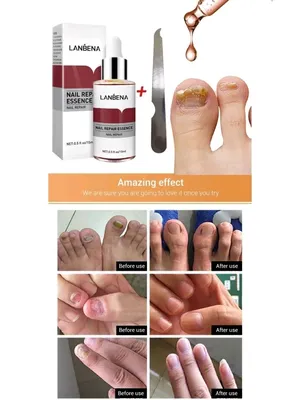 Изображение грибка ногтя на руке: как избежать заражения