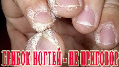 Фотография грибка ногтя на руке: как правильно диагностировать грибок