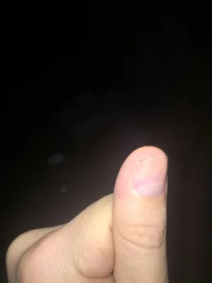 Изображение грибка ногтя на руке: Скачать бесплатно