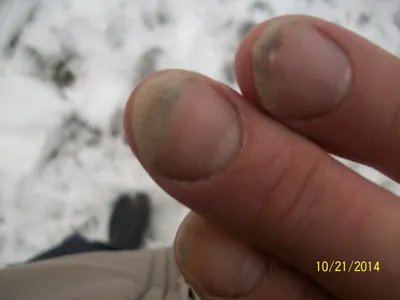 Картинки грибка ногтей рук для медицинских статей