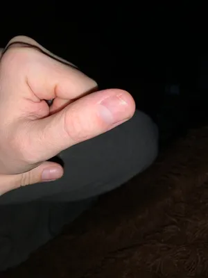 Фото грибка ногтей рук для обучения