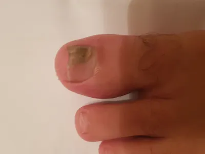 Фотографии грибка ногтей рук для пациентов