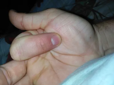 Фото грибка ногтей рук для брошюр о здоровье