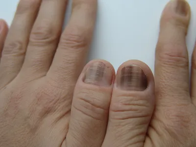 Картинки грибка ногтей рук для медицинских сайтов