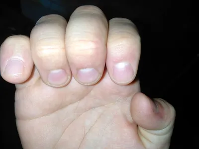 Фото грибка ногтей рук для рекламы медицинских услуг