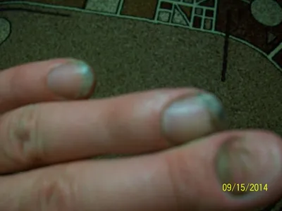 Картинки грибка ногтей рук в формате PNG