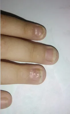 Изображения грибка ногтей рук в HD
