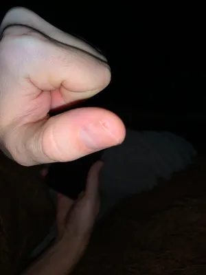 Фото грибка ногтей рук в высоком разрешении