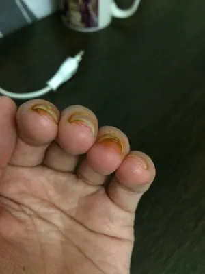 Фото грибка на пальцах рук в разных ракурсах