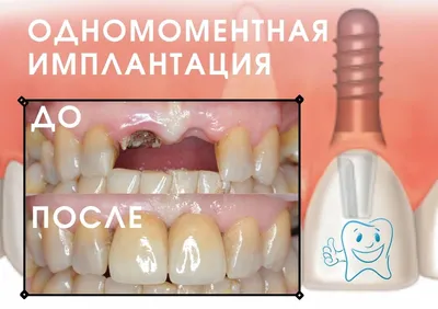 Имплантация зубов - стоит ли делать? - Cтоматология Май