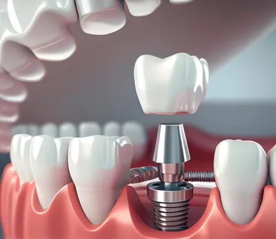 Одномоментная имплантация одного зуба | Стоматология Улыбка
