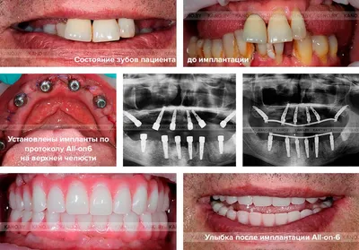 Имплантация при полном отсутствии зубов | Цены
