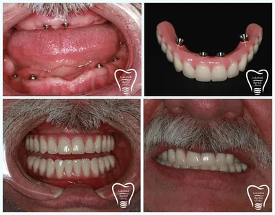 Одномоментная имплантация зубов в Калуге цены
