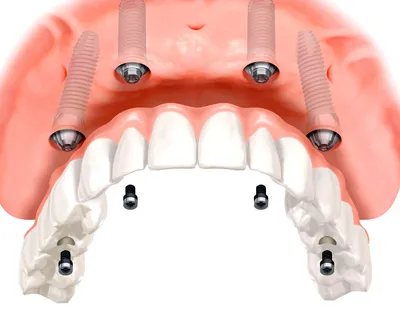 Недорогая имплантация зубов в г. Челябинск с максимальной гарантией