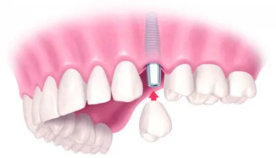 Имплантация зубов на верхней челюсти
