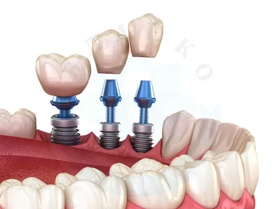 Базальная имплантация зубов - цена в Санкт-Петербурге
