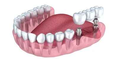 Имплантация зубов в Курске: цены на имплантацию зубов в стоматологии Doctor  Smile