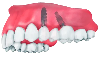 Имплантация с протезированием за 24 часа в Перми - ООО «Центр Стоматологии  32 Практика»