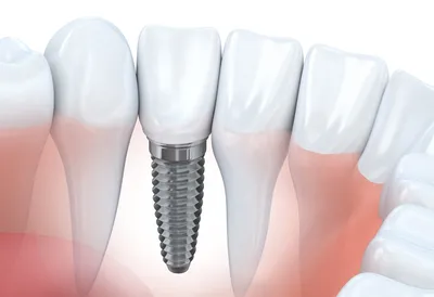 Имплантация зубов / протезирование (до и после)