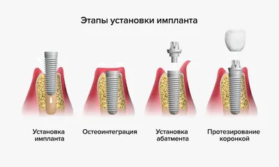 Как устанавливают импланты зубов – этапы установки импланта зуба