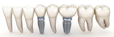 Имплантация зубов в Подольске и риски с ней связанные | Стоматология Улыбка