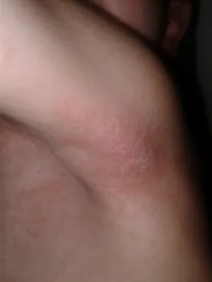 Инфекционный дерматит на руках: изображение в высоком разрешении
