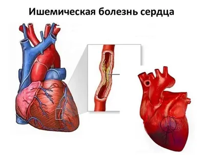 ГКБ №31 им. академика Г.М. Савельевой - Ишемическая болезнь сердца –  симптомы и лечение в Городской клинической больнице №31