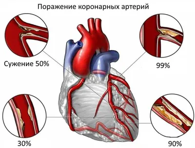 Лечение ишемической болезни сердца в санатории Архипо-Осиповка