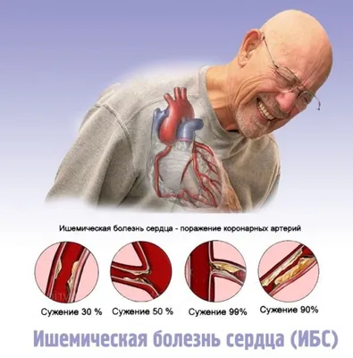 Ишемическая болезнь сердца (ИБС): симптомы, диагностика, лечение | МРТ  Эксперт