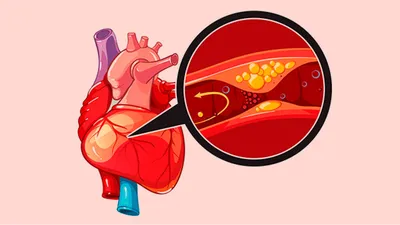 Ишемическая болезнь сердца: что это и как лечить | Медицинская энциклопедия  | Дзен